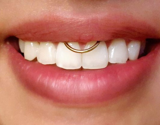 پیرسینگ حلقه کلیکر طلایی(گوش،لب،بینی،سپتوم،اسمایل)